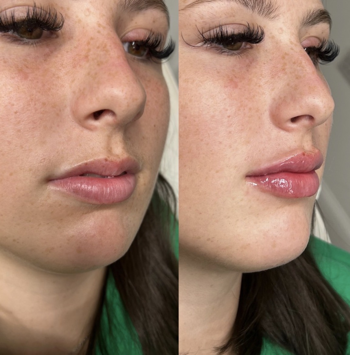 Lip filler before and after result