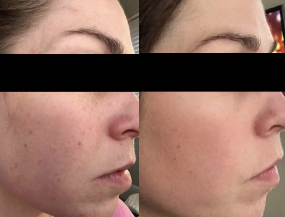 Obagi before and after result